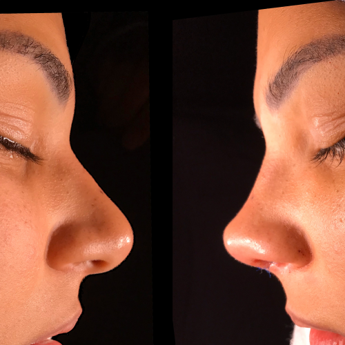 Rinoplastia Perfil